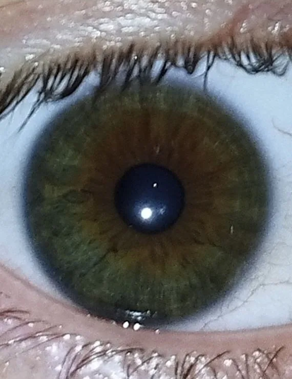 Close-up iris photograph from an anonymous person used for a lung scar tissue example
