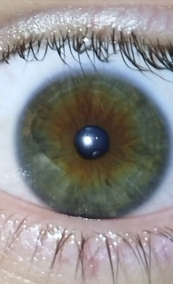 Close-up iris photograph from an anonymous person used for an ear mercury deposit example