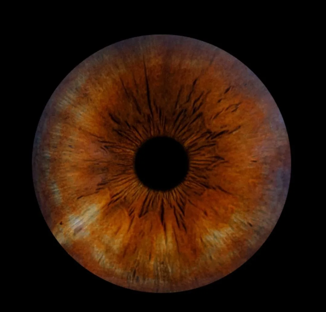 Close-up brown right iris photograph used for a liver scarring and toxic deposit example