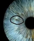 Oliver's iris on December 18th 2025 with the circled lesion area opened