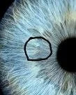 Oliver's iris on December 29th 2025 with the circled lesion area faintly visible