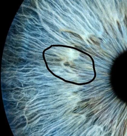 Oliver's iris on May 5th 2025 with a circled lesion area